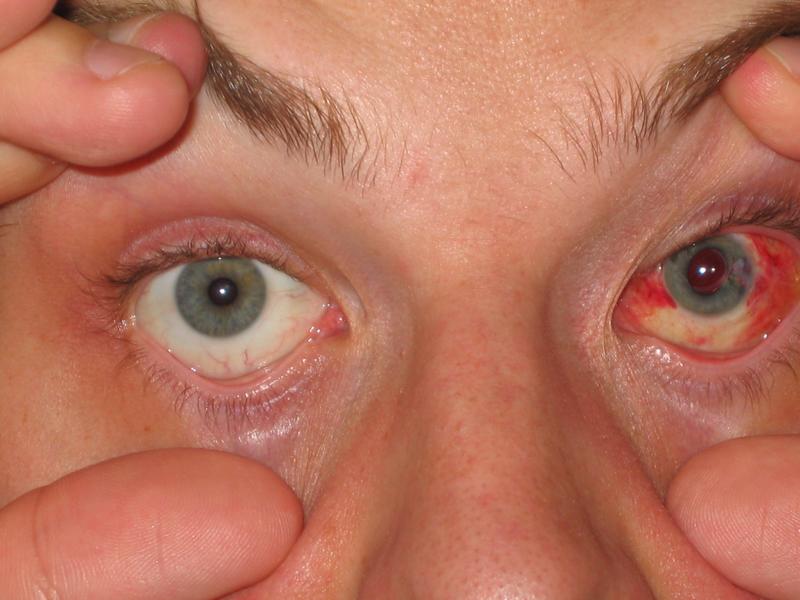 Closeup of Sascha's eyes shortly after surgery